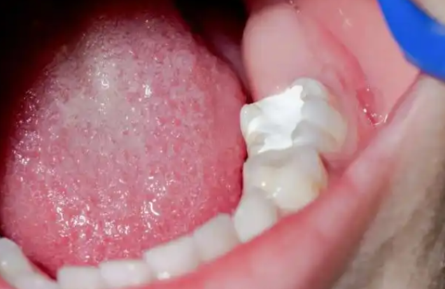 p60补牙多少钱？3M树脂后牙修复价格300-1200元，连锁诊所更优惠！