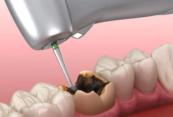 四、2026年3M P60补牙价格趋势与性价比分析