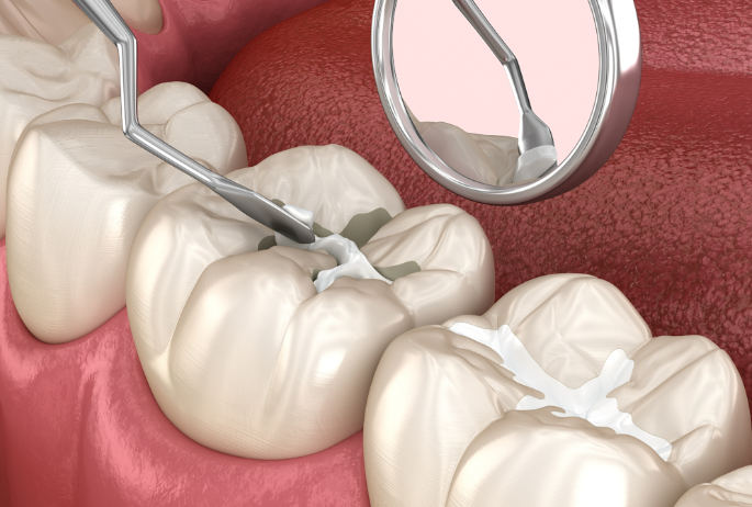 三、2026年3M P60补牙价格对比与选择建议