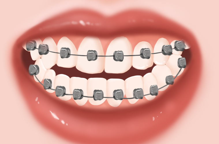 二、40岁矫正牙齿的常见方式：如何选择较适合自己的方案