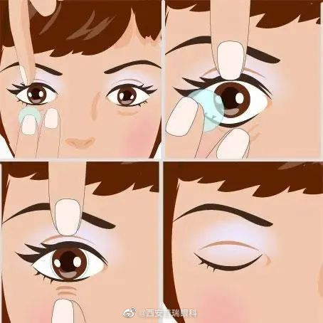 二、角膜塑形镜全套费用解析|从验配到维护的花费明细