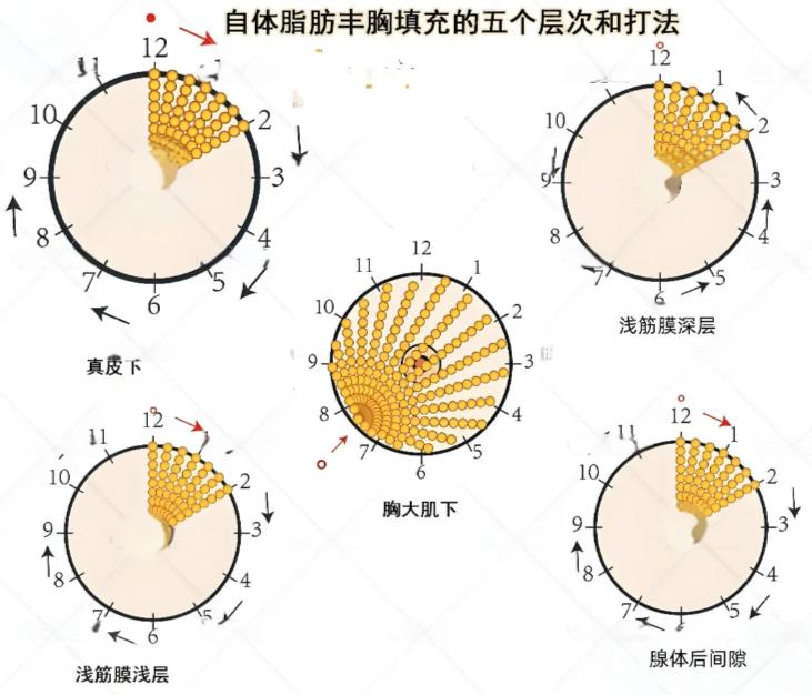 二、深圳陈星光隆胸怎么样｜术后疗效与用户评价