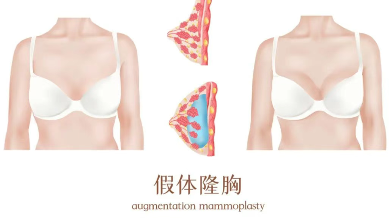 三、郝永生隆胸价格明细的附加技术解析