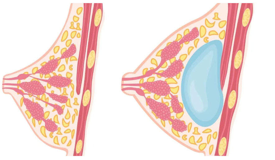 二、郝永生隆胸价格明细对比分析