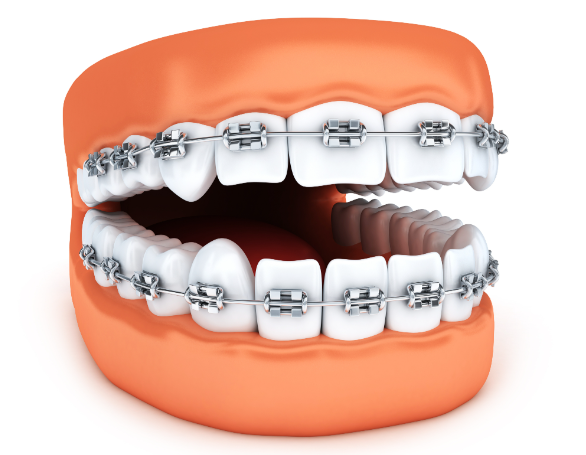 二、自锁托槽种类的临床应用与选择