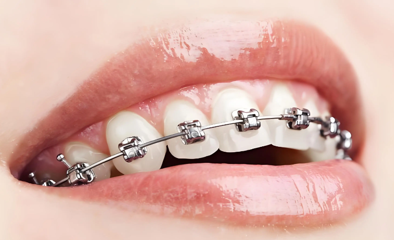 三、自锁托槽种类的价格与性价比分析