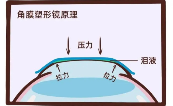 阿尔法角膜塑形镜左右眼颜色怎么分？蓝白配色区分左右眼最全指南