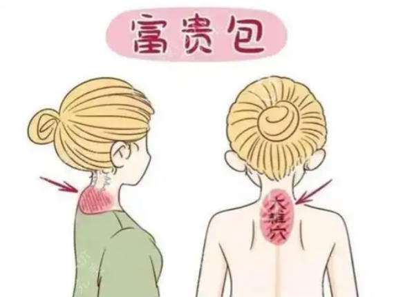 五、徐州哪里治疗富贵包好?真实实例与患者反馈参考