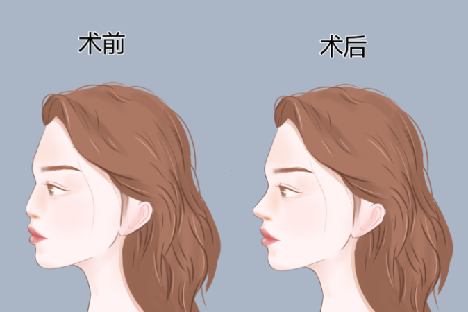 单纯垫鼻尖需要多少钱？8000-30000元，材料影响大！