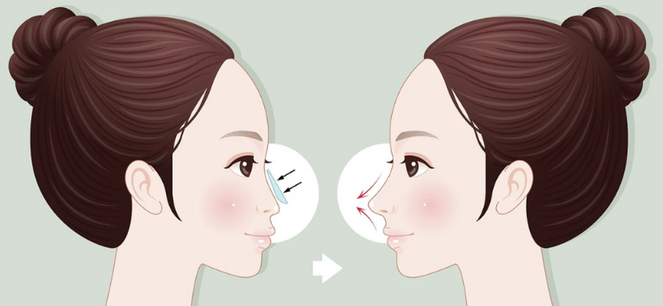 四、硅胶隆鼻价格影响因素解析