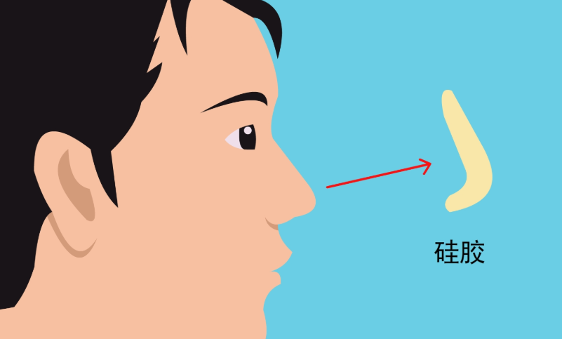 三、硅胶隆鼻附加项目费用