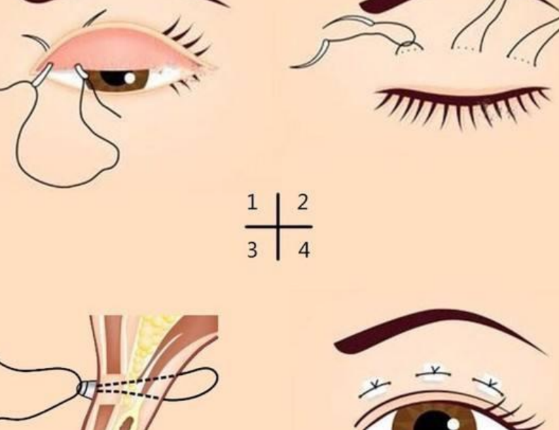 谭敏峰双眼皮属于什么档次？98%满意！8000元起自然妈生感无痕修复