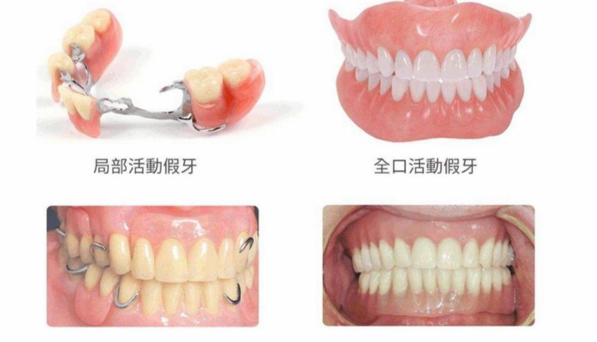 一、单颗吸附性义齿能咀嚼吧｜咀嚼功能与适用场景解析