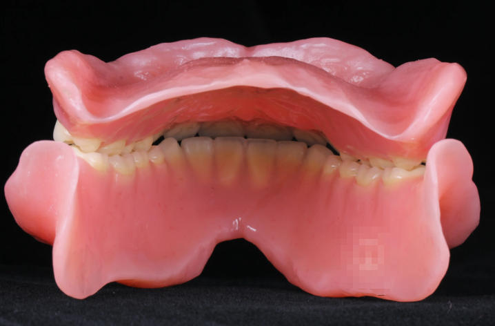 单颗吸附性义齿优缺点全揭秘：半口修复是否值得入手？