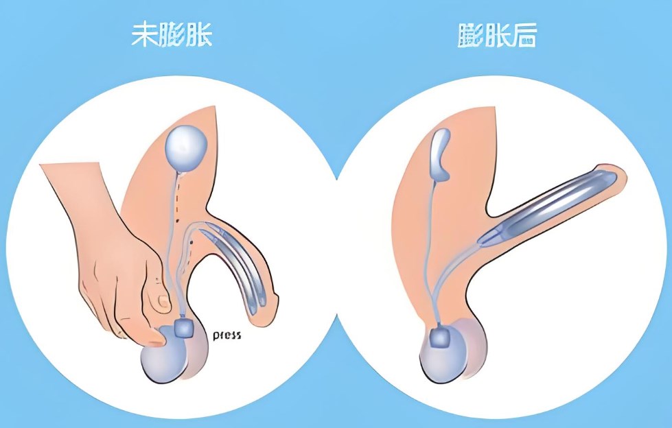 三、术后护理规范延长疗效