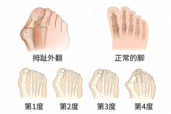 大脚骨1.png 大脚骨1.png