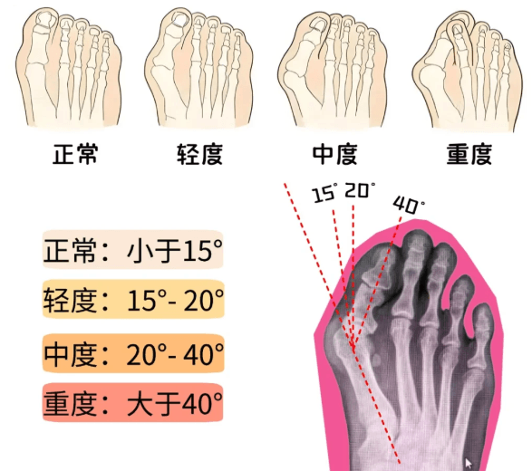 大脚骨1.png 大脚骨1.png