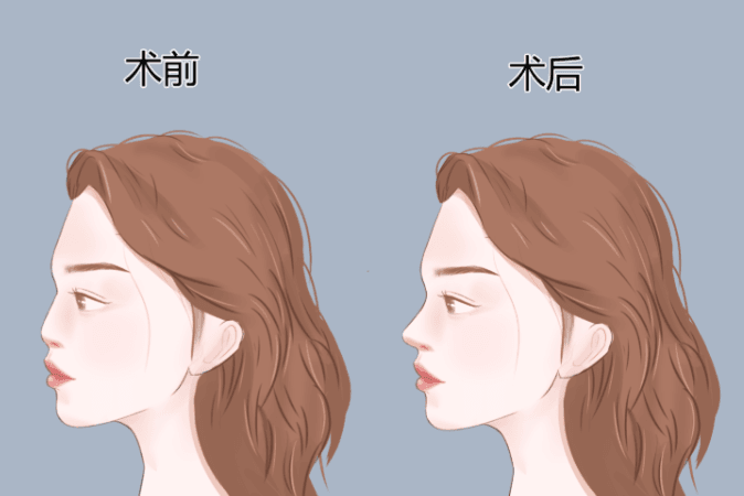 隆鼻 隆鼻
