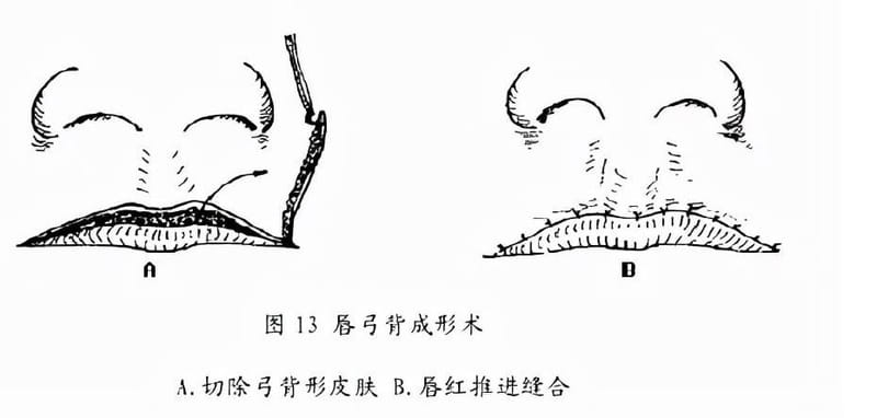 唇裂修复