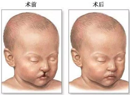 唇裂修复