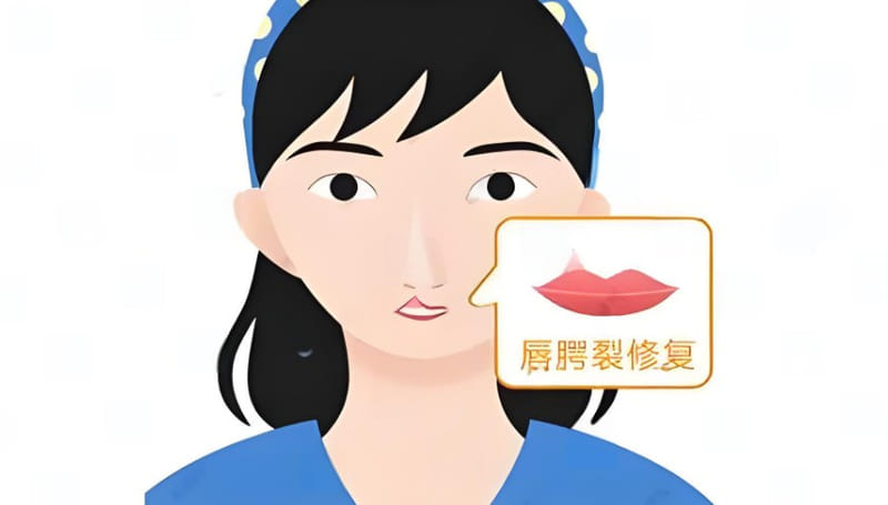 唇裂修复