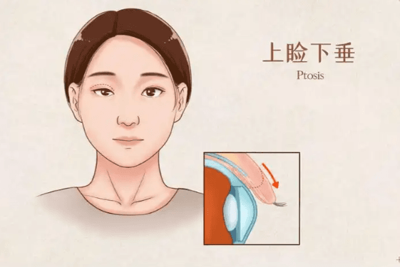 上睑下垂.png