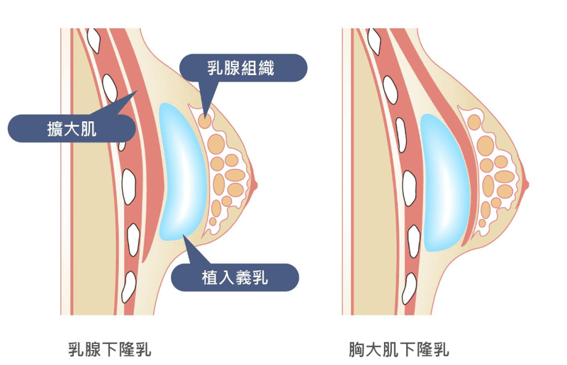 隆胸项目图